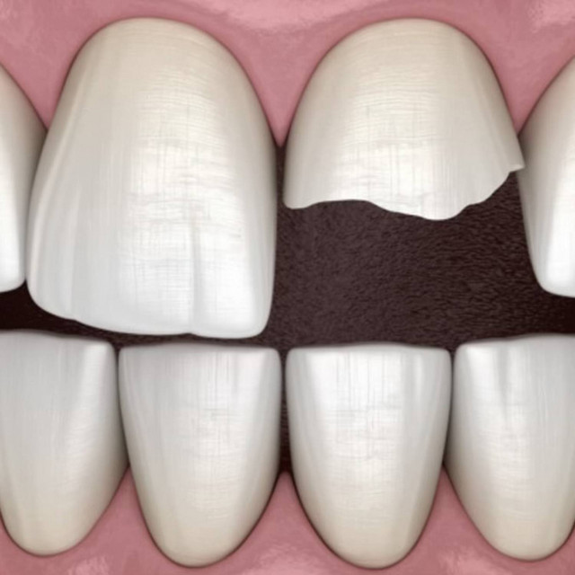 'cracked my tooth' cover art